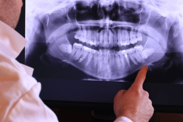 Best Emergency Dental Extractions in East Niles, CA